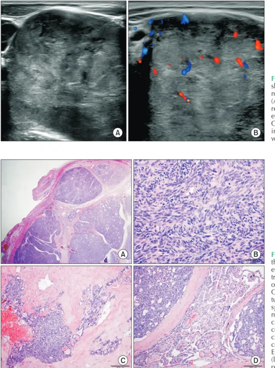 Fig. 3. On ultrasound, mass  showed heterogeneous echo ge­