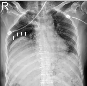 Fig. 1. Initial chest radiologic findings show elevated right  diaphragm (white arrows).