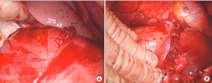 Fig. 3. (A) Operative findings show diaphragmatic rupture with herniation of liver. (B) Operative findings show diaphragmatic  repair done by interrupted pledgeted sutures.