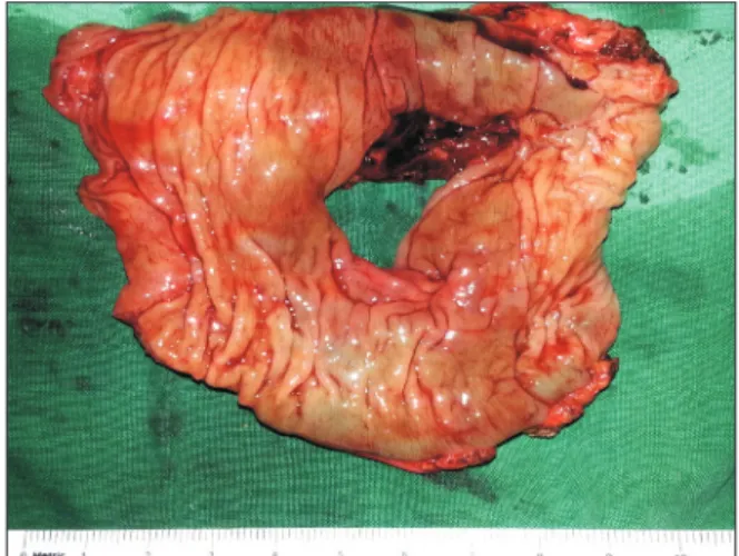 Fig. 4. Resected segment of bowel shows rectal perforation  with sharp margin.