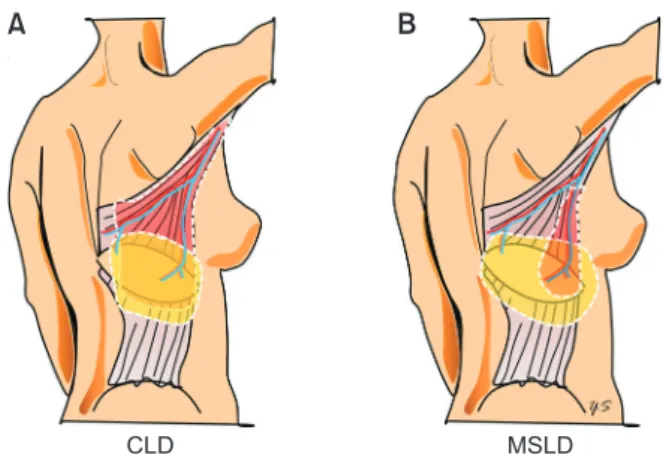 Fig. 1. The area of flap elevation. Flap is elevated along  dotted line. Red-shaded area shows muscle part of flap, while  yellow-shaded area shows fat tissue of flap