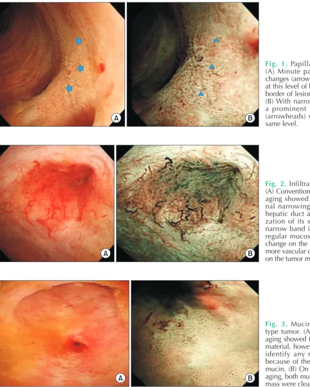 Fig. 1. Papillary type cancer. 
