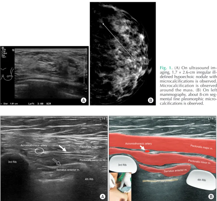 Fig. 1. (A) On ultrasound im- im-aging, 1.7 × 2.6-cm irregular  ill-defined hypoechoic nodule with  micro calcifications is observed