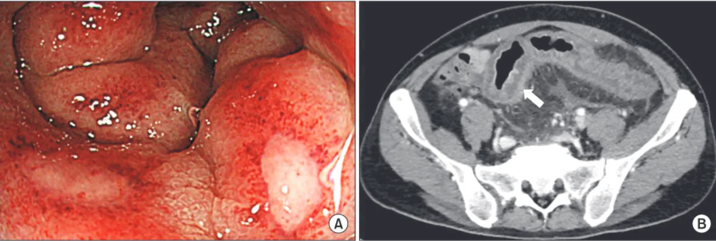 Fig. 1. (A) Colonoscopy shows abnormal colonic mucosa with multiple ulcer, exudate and hemorrhage from the splenic  flexure to the upper rectum