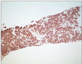 Fig. 1. Multiple subcutaneous nodules on the patient’s back. Fig. 3. Immunohistochemical staining was positive for CK20 (×100).