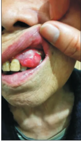 Fig. 4. Rapidly increasing gingiva nodule.