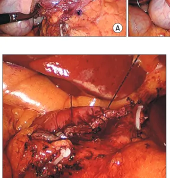 Fig. 1. (A) Laparoscopic rein- rein-forcement suture (LARS)  com-mence from upper to lower  part on staple-line of duodenal  stump using barbed suture