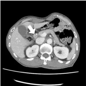 Fig. 3 presented CT finding of duodenal stump treated LARS  at postoperative 6 months.