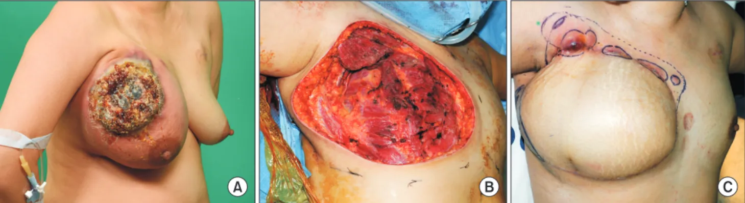 Fig. 1. (A) An inflammatory and ulcerative mass in the right breast. (B) Post modified radical mastectomy image showing  en bloc removal of the tumor including the invaded pectoralis muscle