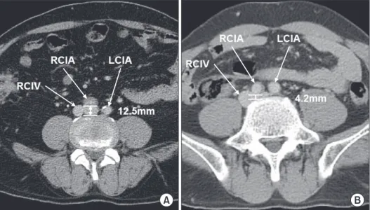 Fig. 1 shows the measurement method. The same method was  incorporated in the case with a left-sided inferior vena cava (IVC)  or other types of IVC abnormalities