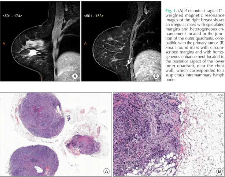 Fig. 1. (A) Postcontrast sagital T1- T1-weighted magnetic resonance  im ages of the right breast shows  an irregular mass with spiculated  mar gins and heterogeneous  en-hancement located in the  junc-tion of the outer quadrants,  com-pa tible with the pri