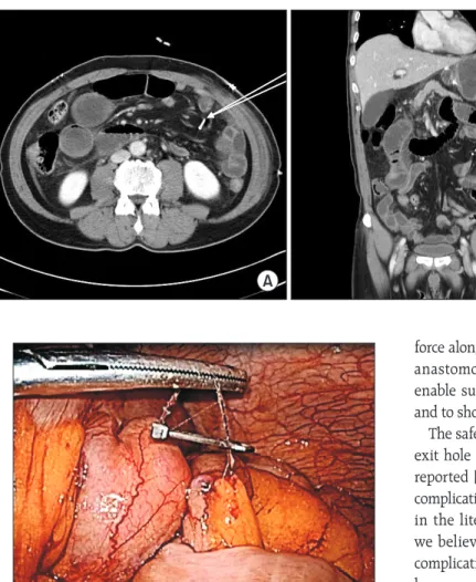 Fig. 2. Laparoscopic intraoperative image shows small bowel  was internally herniated between V-Loc (Covidien, New  Haven, CT, USA) wire end and surgical clip.