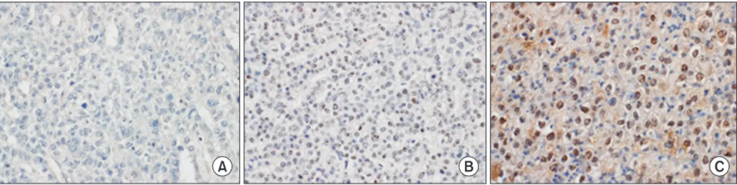 Fig. 1. The representative sections of Sal-like protein 4 immunohistochemical staining in hepatocellular carcinoma