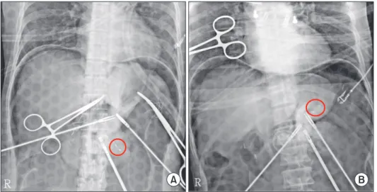 Fig. 3. Tumor localization by intraoperative endoscopy. Two  surgeons determined the location of tumor in the lapar­