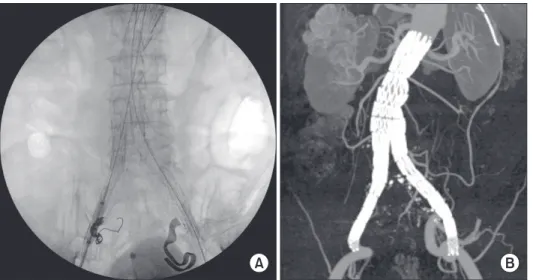 Fig. 1. (A) Both iliac stent­graft  limbs were deployed on external  iliac arteries. The right internal  iliac artery was embolized with  coils, and adjunctive iliac stents  were deployed on both exter nal  iliac arteries