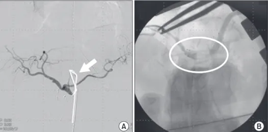 Fig. 1. A 57­year­old female who  re ceived pylorus­resecting PD for  pancreatic head cancer, after the  resection of gastroduodenal artery  (GDA); the flow of common  hepatic artery was not detected  and ce liac axis stenosis was  identified  in tra opera
