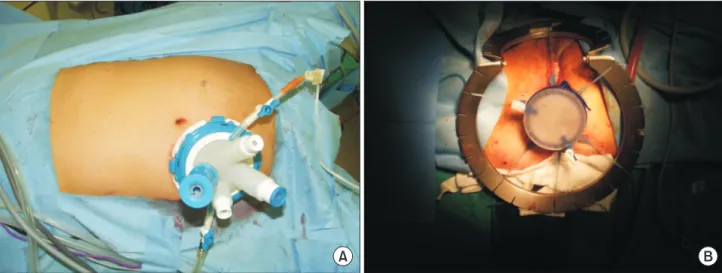 Fig. 1. Illustration of the procedure. (A) An Octoport (Dalim, Seoul, Korea) was placed on the potential ileostomy site of the  right iliac fossa