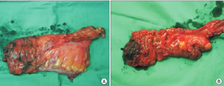 Fig. 2. Grading of surgical specimens. (A) The specimen removed from patient No. 1 was graded as ‘complete’ total mesorectal  excision (TME) according to the Quirke method