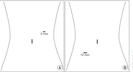 Fig. 1. Trocars placement of re­