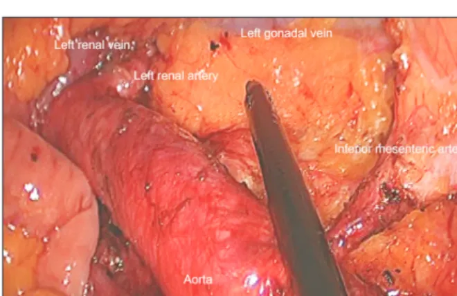Fig. 1. Final operative finding of laparoscopic resection and  paraaortic lymph node dissection (66­year­old male patient  with pathologically positive paraaortic lymph nodes).