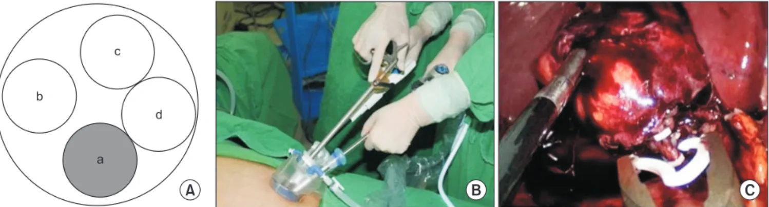 Fig. 1. (A) Port placement for 3-channel single incision laparoscopic cholecystectomy (SILC) using a Gloveport 431 (Meditech  Inframed, Seoul, Korea)