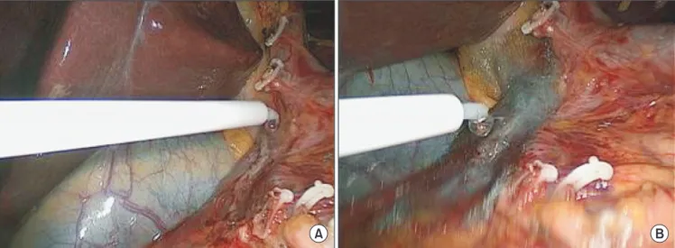 Fig. 3. Ultrasound­guided percutaneous transhepatic biliary  drainage (PTBD) was used to divert bile from the duodenal  stump