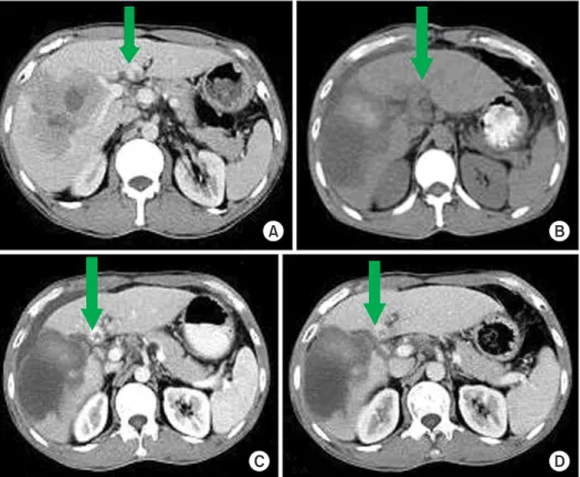Fig. 3. Comparison of the future  liver remnant at different time  after the first-stage operation