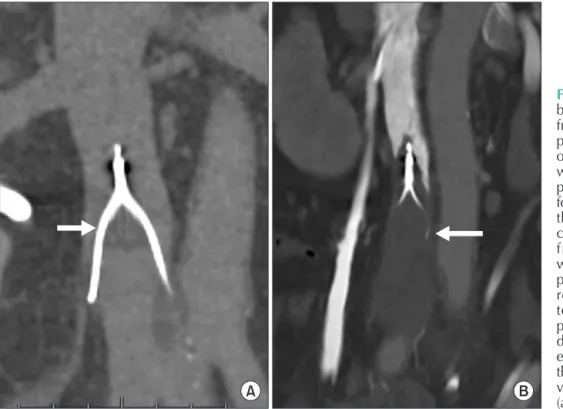 Fig. 1. Examples of filter throm­