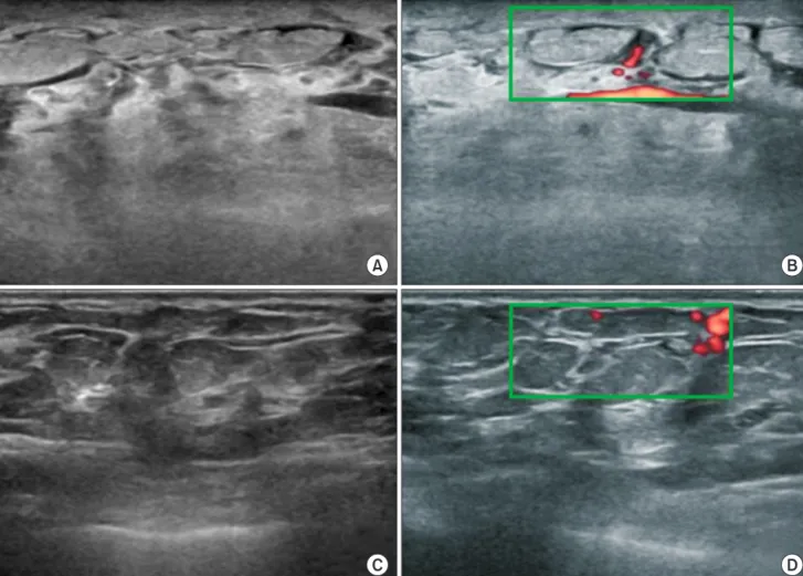 Fig. 1. Ultrasound image of necrotizing fasciitis. Ultrasound revealing marked subcutaneous and glandular edema,  intraglandular fluid collection, brighter echo (A), and decreased superficial blood flow in Doppler sonogram (B) compared to  that in the cont