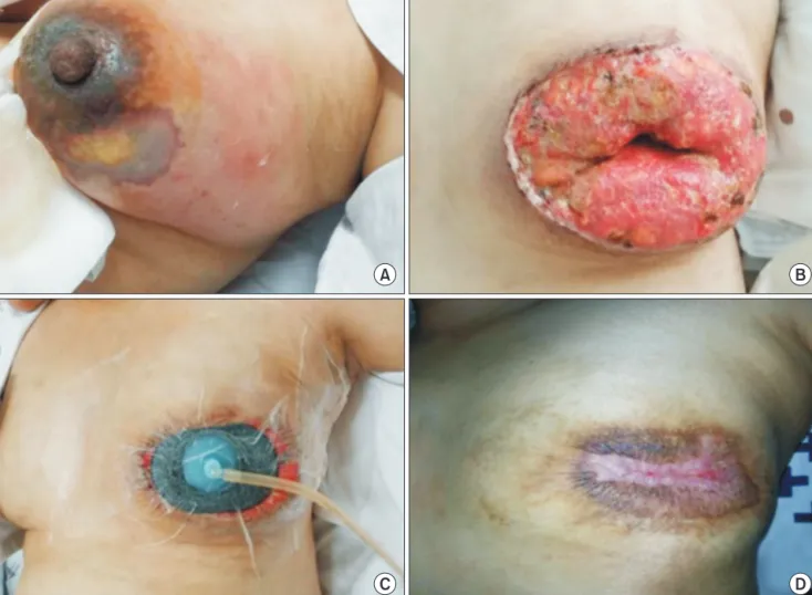 Fig. 2. (A) Necrotizing fasciitis of the left breast demonstrating edema, inflammation, and an area of necrosis