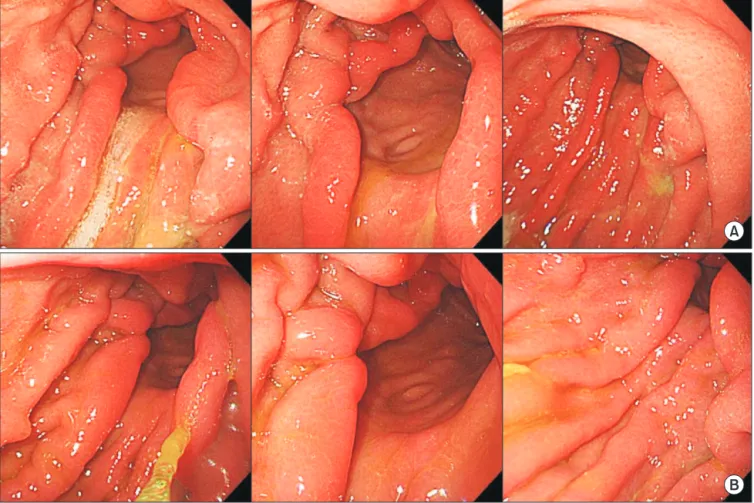 Fig. 5. Residue, gastritis, bile reflux classification accor ding to  endoscopic finding at 6 months (A) and at 18 months (B) after  operation.
