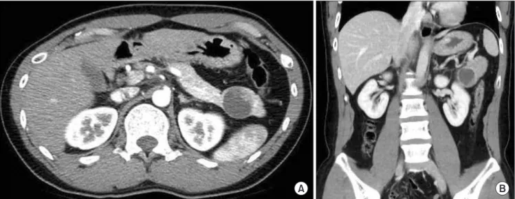 Fig. 1. A 3.3 cm × 3.0 cm well-defined cystic mass in the tail of the pancreas. This mass has a peripheral solid portion with  strong enhancement