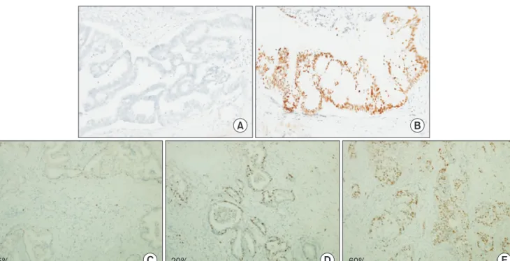Fig. 1. Representative immunohistochemical staining of p53 and Ki-67 in pancreatic head cancer