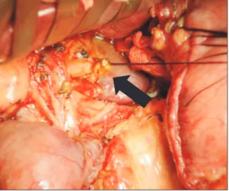 Fig. 3. Specimen shows that the accessory common bile  duct (ACBD) opening is located in the lesser curvature of  the stomach, and ACBD site is away from the gastric cancer  lesion of the antrum.