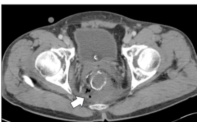 Fig. 1. Presacral abscess (arrow) secondary to anastomotic  leakage is detected on abdominopelvic CT.