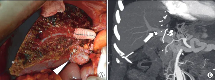 Fig. 2. (A) End-to-end portal anastomosis was constructed between the graft and common cloaca formed by the confluence of  paracholedochal veins (arrowhead)