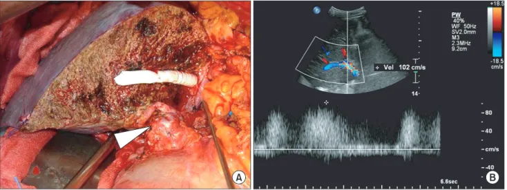 Fig. 3. (A) The complex common orifice formed by venoplasty from paracholedochal collaterals and native portal vein was  anastomosed to the donor portal vein (arrowhead)