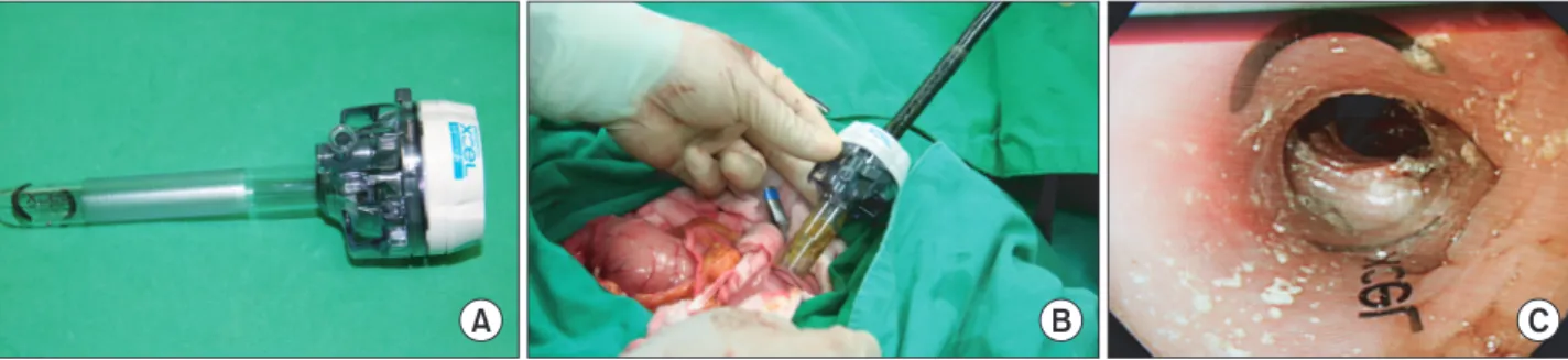 Fig.  5.  Endoscopic  procedure  appearance. (A) There is a  phyto-bezoar in hepatico-jejunos tomy  stoma