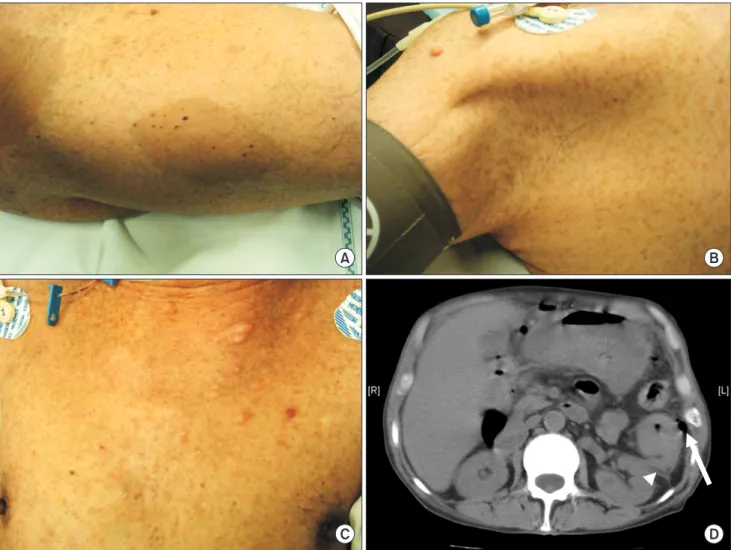 Fig. 1. Clinical manifestations of a 61-year-old male patient. (A) Cafe-au-lait macules in the right thigh