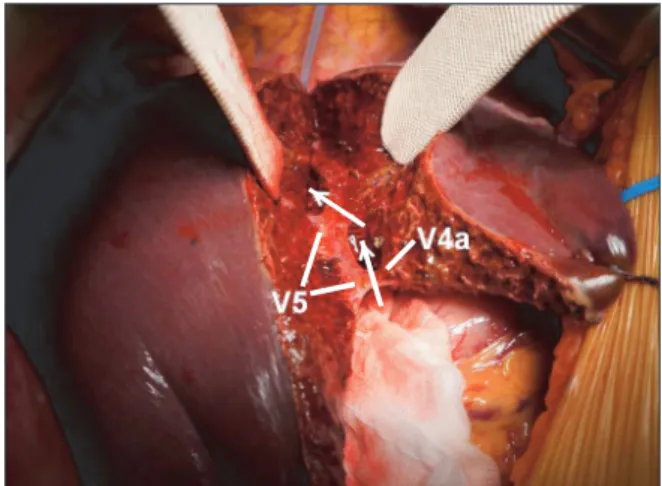 Fig. 1. After hepatic parenchyma dissection was performed,  left side of caudal middle hepatic vein trunk and right side  of cranial middle hepatic vein trunk were fully exposed