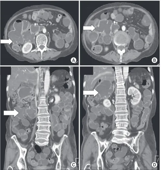 Fig. 1. Diverticula in the second and third portions of the  duodenum on gastroduodenoscopy.