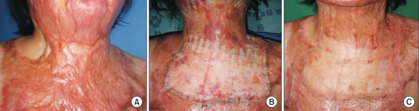 Fig. 1. (A) Preoperative image showing the split-thickness skin graft (STSG) with AlloDerm of a 39-year-old female with 73% 