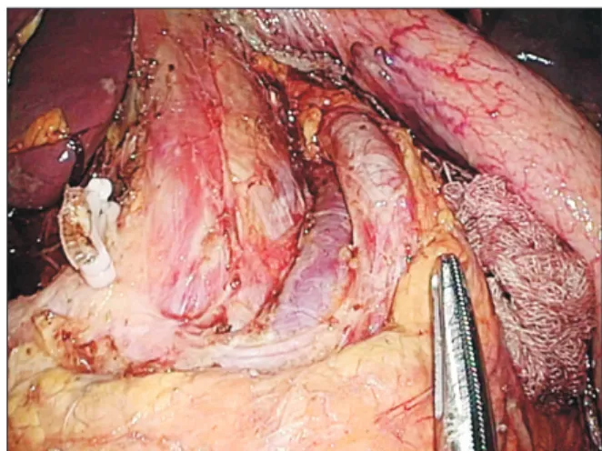 Fig. 3. An 11p lymph node dissection with proper exposure  of the splenic artery and vein.