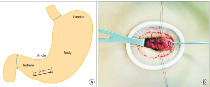 Fig. 2. (A) Gastric incision after inserting first wound retractor. (B) Pulling the stomach down by grasping with Babcock forcep