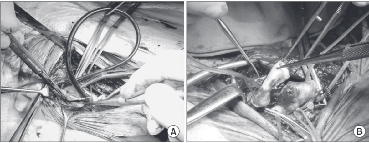 Fig. 1. Conventional carotid endarterectomy with shunt (A) and eversion carotid endarterectomy (B).