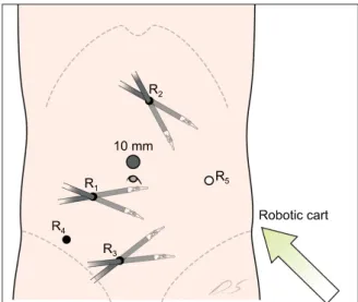 Fig. 1. Setup for the colonic phase in a robotic lateral pelvic 