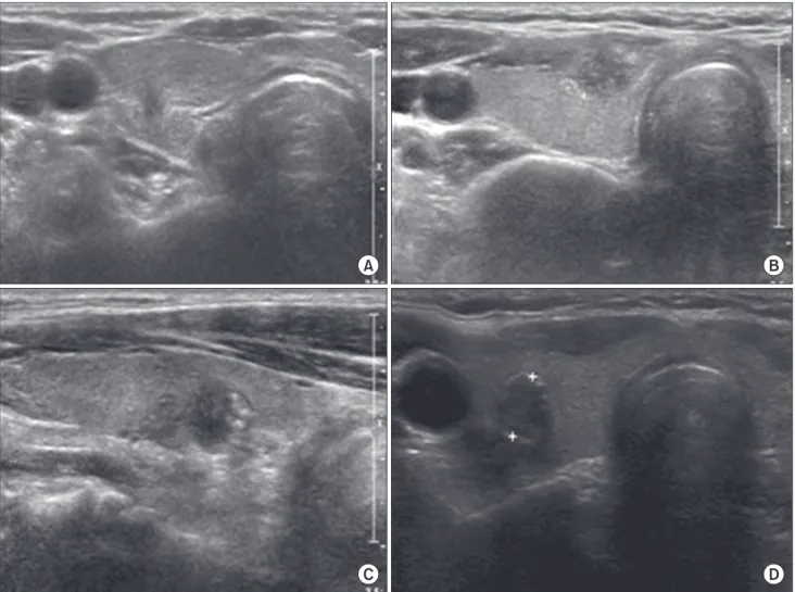 Fig. 1. Papillary thyroid microcarcinoma calcification patterns on neck neck ultrasonography