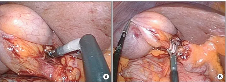 Fig. 6. Dissection of the gallbladder off the liver bed using  suction-hook bovie divices.