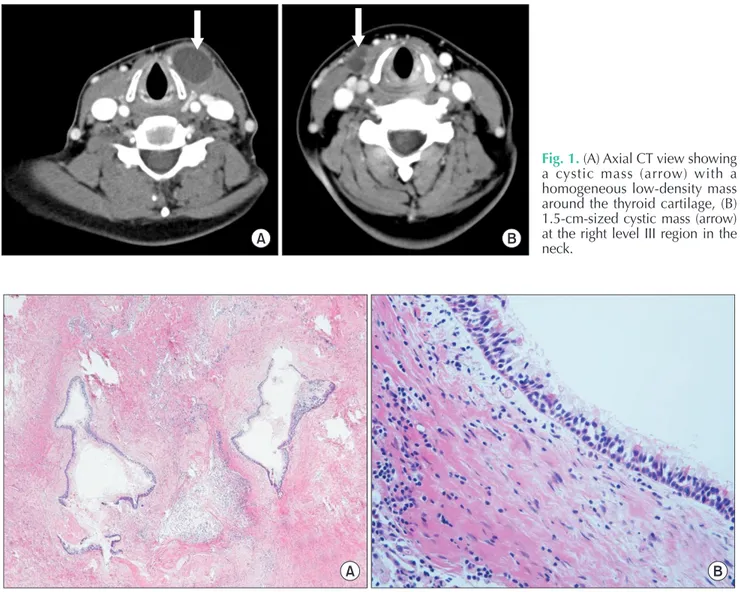 Fig. 2. The pathologic findings of bronchogenic cyst. (A) The lesion comprises variable sized cysts and fibrotic tissue with  inflammation (H&amp;E, ×40)
