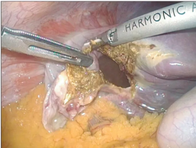 Fig.  1. Aspiration of cystic fluid without spillage before 